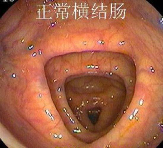 正常胃肠镜图片：正常横结肠