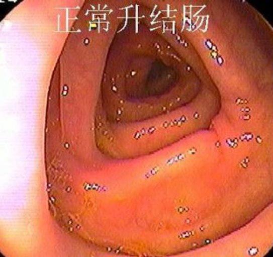 正常胃肠镜图片：正常升结肠