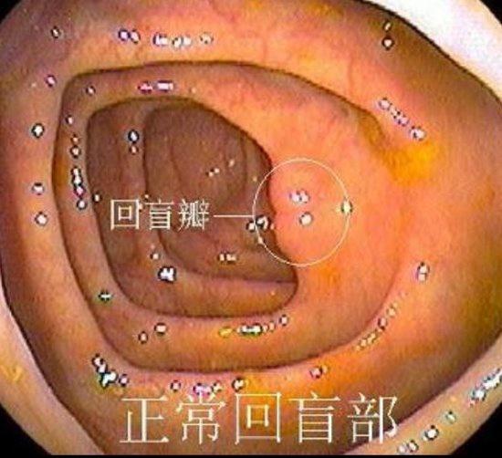正常胃肠镜图片：正常回盲部