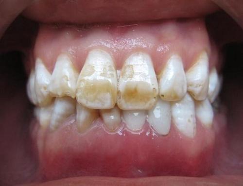 氟中毒的临床表现－氟斑牙
