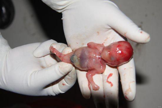 26周胎儿引产图片图片