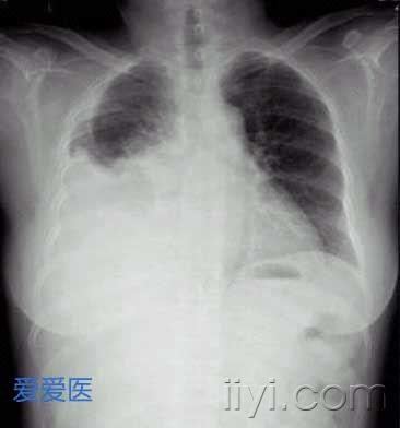 胸腔积液的X线表现