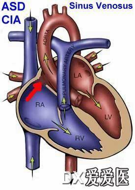 房間隔缺損心臟圖片2
