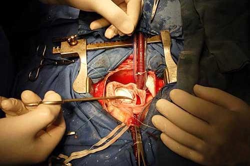 24岁女孩心脏手术图片
