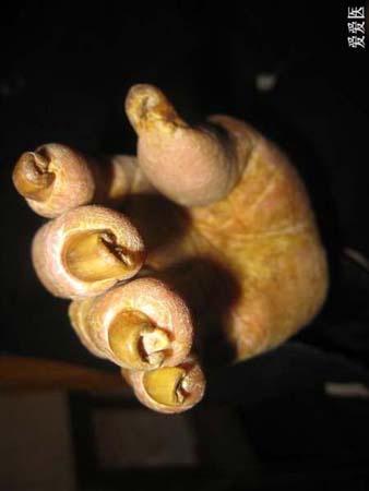 毛发红糠疹
