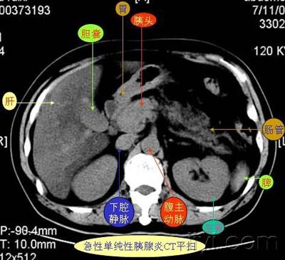 腹部ct8