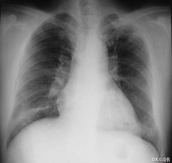 病案讨论—肺部阴影一个月