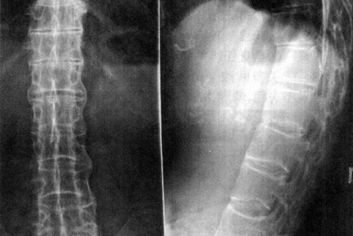 强直性脊柱炎X线