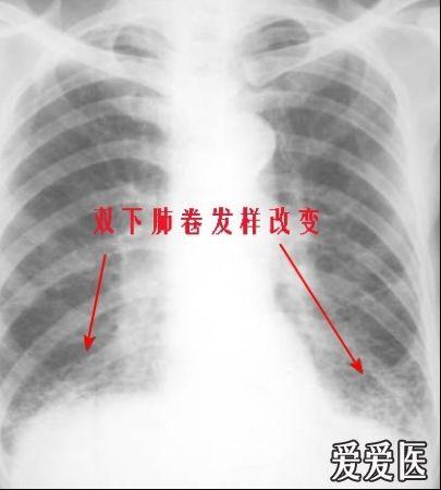 支气管扩张胸片图片