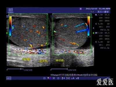超聲可見右側睪丸較左側明顯增大,腫脹,回聲均勻減低,cdfi:可見豐富線