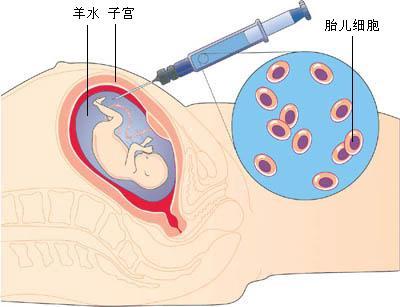 羊水栓塞护理措施六要素