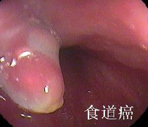 食管癌的护理措施