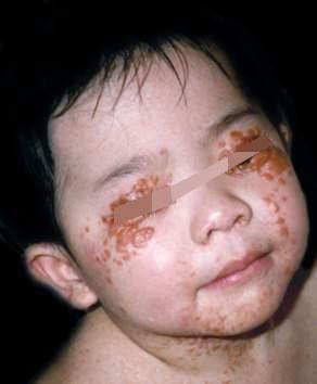 儿童黄瘤病图片