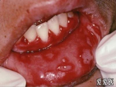 小儿疱疹性口炎亦称小儿疱疹性齿龈口炎,为单纯疱疹病毒感染所致,多