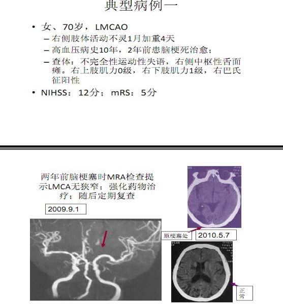 李天晓，非急性期颅内动脉闭塞的再通治疗及评估讨论8