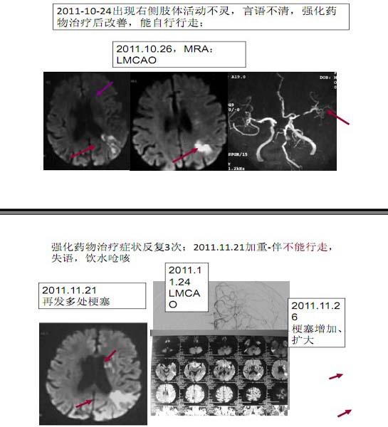 李天晓，非急性期颅内动脉闭塞的再通治疗及评估讨论9