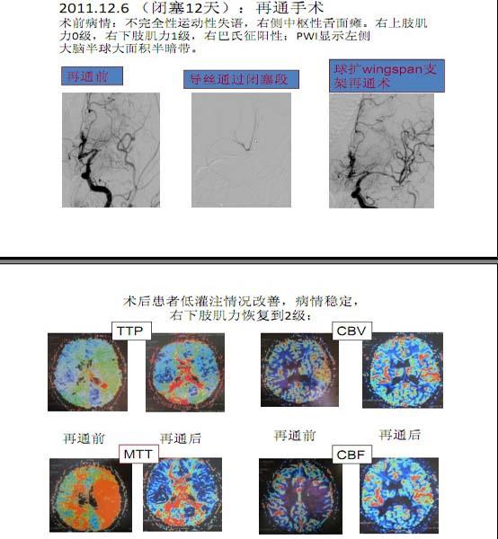 李天晓，非急性期颅内动脉闭塞的再通治疗及评估讨论10