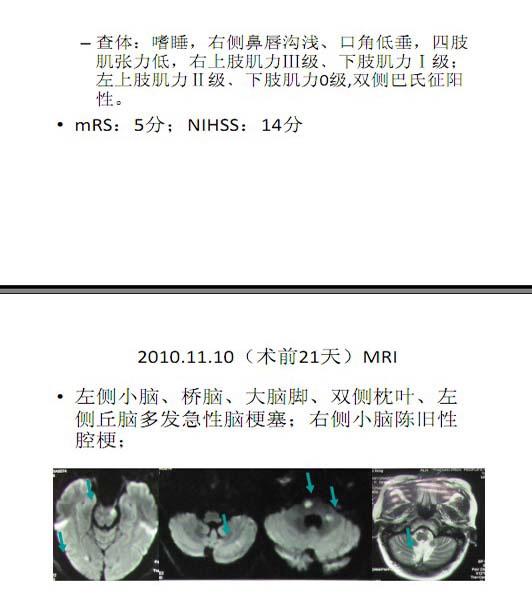 李天曉，非急性期顱內(nèi)動(dòng)脈閉塞的再通治療及評(píng)估討論12