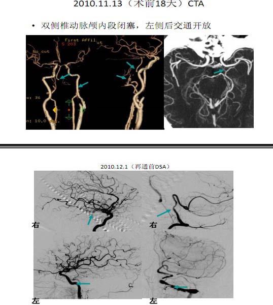 李天曉，非急性期顱內(nèi)動(dòng)脈閉塞的再通治療及評(píng)估討論13