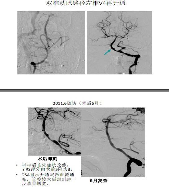 李天晓，非急性期颅内动脉闭塞的再通治疗及评估讨论14