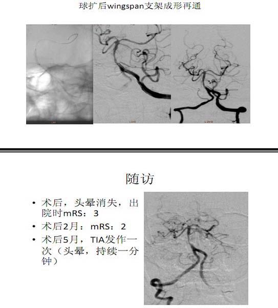 李天曉，非急性期顱內(nèi)動脈閉塞的再通治療及評估討論17