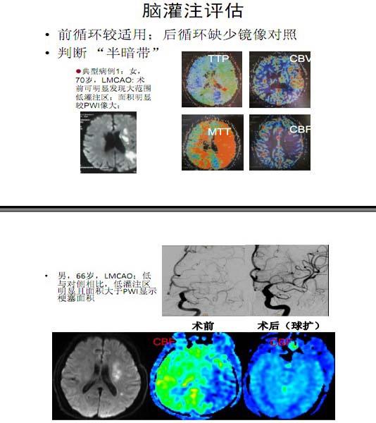 李天曉，非急性期顱內(nèi)動脈閉塞的再通治療及評估討論20