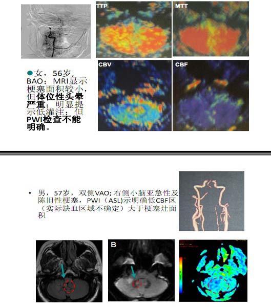 李天曉，非急性期顱內(nèi)動脈閉塞的再通治療及評估討論21