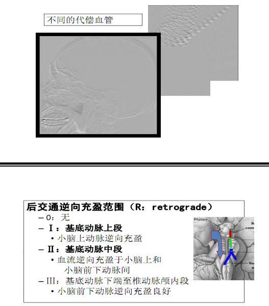 李天曉，非急性期顱內(nèi)動脈閉塞的再通治療及評估討論24