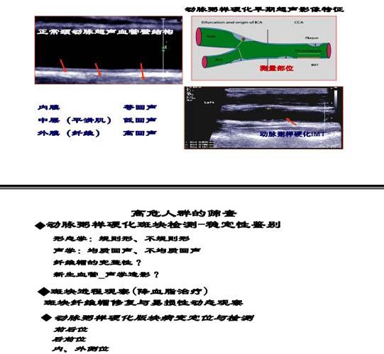 华扬，脑卒中高危人群的规范化血管超声检测与治疗评估5