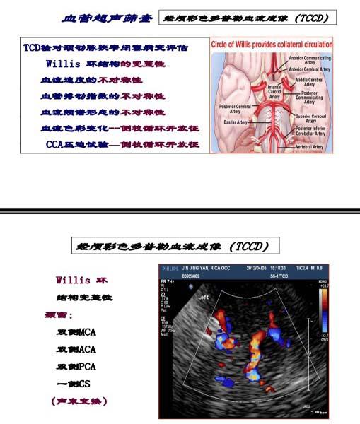 华扬，脑卒中高危人群的规范化血管超声检测与治疗评估7