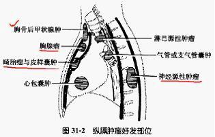 纵隔肿瘤