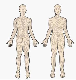 与blaschko线一致的线状苔藓一例