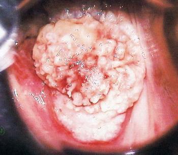 我國婦女宮頸癌發病呈年輕化趨勢