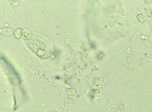 阴道清洁Ⅱ度:有部分阴道杆菌及上皮细胞,部分脓细胞和杂菌阴道清洁Ⅲ