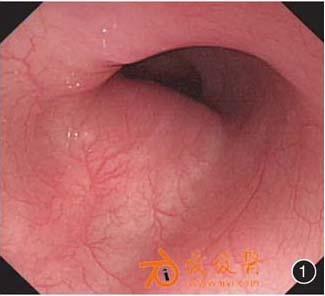 胃镜检查示:食管中段即门齿约25cm处见一包块样隆起,表面光滑,活检钳