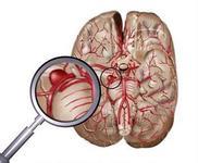 新型臨床決策規則有助診斷蛛網膜下腔出血