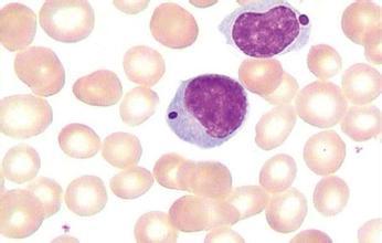 小淋巴细胞性淋巴瘤是什么意思 z1382498956clwbt.jpg