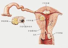 前庭大腺炎