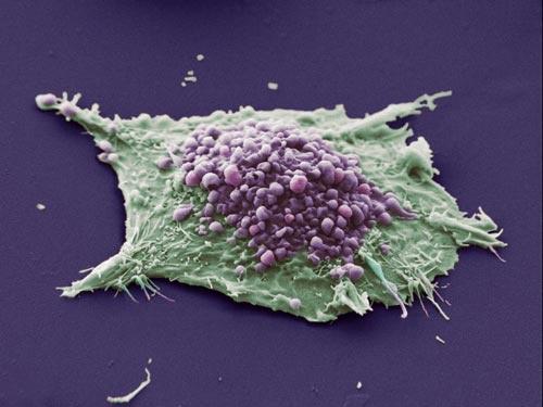PNAS:癌细胞免疫逃逸新机制被揭示