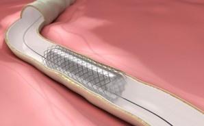 比卢伐定减少PPCI大出血作用被夸大？