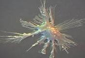 淋巴結結內指突狀樹突細胞肉瘤1例