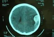 脑卒中病例精选：右侧颞叶出血