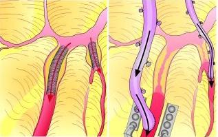 50歲及以下患者：PCI和CABG治療生存獲益旗鼓相當