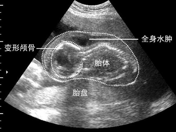 5. 羊水過少.6. 胎盤胎膜可出現部分剝離的聲像.