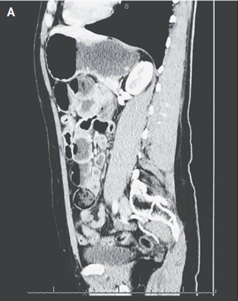 案例学习：一幅令人叹为观止的肠扭转 CT 图
