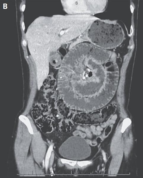 案例学习：一幅令人叹为观止的肠扭转 CT 图