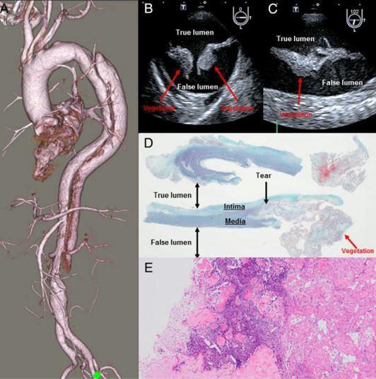 主動脈夾層相關感染性動脈內膜炎一例