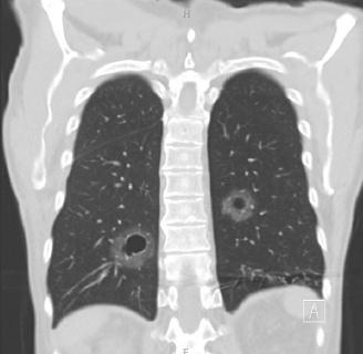 肺内的空洞：原发性肺血管肉瘤一例