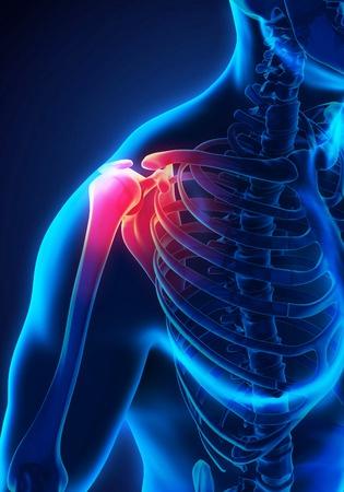 肩部疼痛需详问既往史以防误诊误治