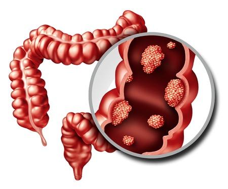 大腸息肉切除后需要定期復查嗎？